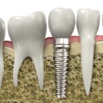 Dental implants are available from our Yuba City dentists.
