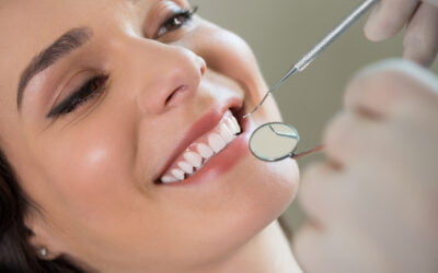 Myths About Veneers