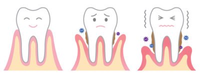 Gum Disease Description