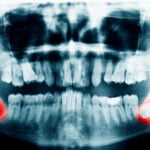 Wisdom Teeth Extraction