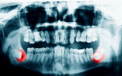 Benefits of Dental X-rays