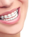 Ceramic Braces