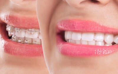 Braces or Invisalign?