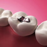 A close-up of three molar teeth on a pink background, focusing on the middle tooth which has a silver dental filling. The surrounding teeth are healthy and white, highlighting the contrast of the metallic filling.