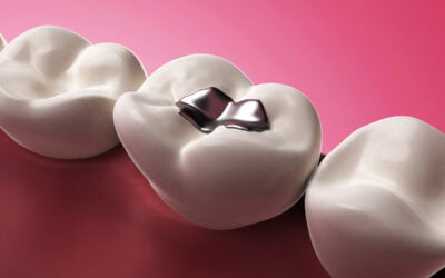 Should You Replace Your Fillings?
