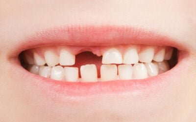 Should You Pull the Tooth?