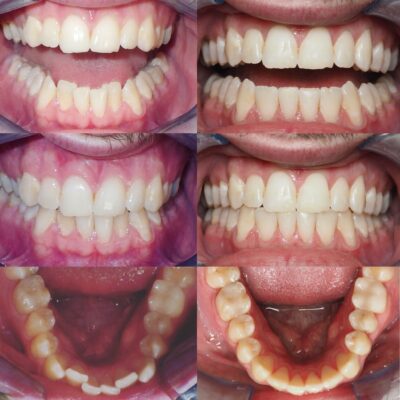 A collage of six images showing the dental progress of a patient before and after orthodontic treatment. The top row displays the front view of the teeth before treatment, highlighting misalignment and crowding. The middle row shows the same front view after treatment, with teeth appearing straightened and well-aligned. The bottom row captures the bottom teeth before and after treatment, demonstrating significant improvement in alignment and spacing. The images collectively illustrate the effectiveness of the dental treatment.