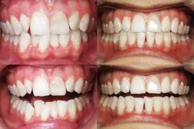 A collage of four images showcasing a dental transformation before and after orthodontic treatment. The top row displays the front and side views of teeth before treatment, highlighting misalignment, crowding, and gaps. The bottom row shows the same front and side views after treatment, with teeth appearing straightened, evenly spaced, and well-aligned. The images collectively illustrate the significant improvement in dental alignment and overall oral health achieved through orthodontic intervention.