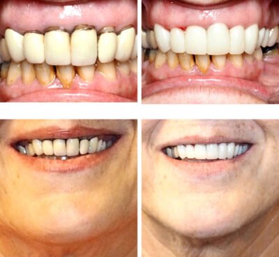 A set of four images showing a before-and-after transformation of dental treatment. The top two images depict close-ups of teeth with significant discoloration, plaque buildup, and gum issues before treatment. The bottom two images show the same mouths with improved dental health, featuring clean, white teeth and healthy gums. The before images highlight dental issues, while the after images display the successful results of dental restoration and cleaning.