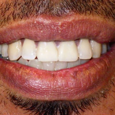 A close-up image of a person's mouth showing their teeth. The teeth are clean and mostly straight, with slight yellowing. The person's lips are slightly chapped, and there is facial hair visible on the upper lip and chin. The image highlights the condition of the teeth and lips.