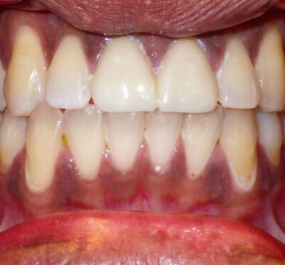 A close-up image of a person's teeth showing both upper and lower rows. The teeth are slightly yellowed with some plaque buildup near the gum line. The lower teeth exhibit mild crowding, while the upper teeth are relatively straight. The gums appear reddish, indicating mild inflammation. The image highlights dental hygiene issues and the alignment of the teeth.