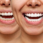 Side-by-side comparison of two smiles showing teeth before and after whitening. On the left, teeth appear stained and discolored, and on the right, the same teeth look significantly whiter and cleaner. This demonstrates the effectiveness of dental whitening treatments