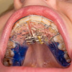 Youth with installed palate expander in their mouth. Palate expanders are designed to assist with orthodontic treatments helping to better align the teeth with the correct positioning of the palate.