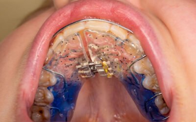 Understanding Palate Expanders